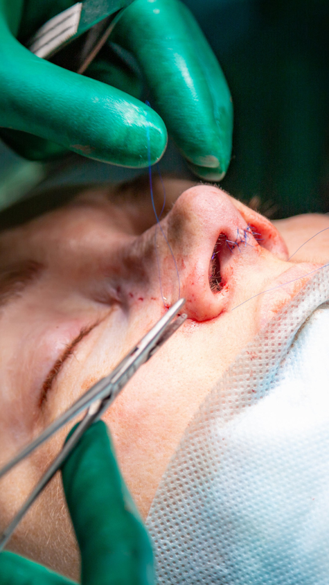 Operacja plastyczna nosa